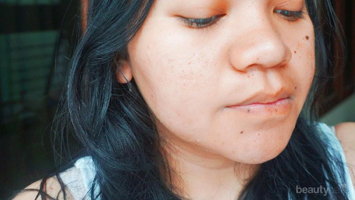 [FORUM] Pernah Coba Vitacid Buat Hilangkan Komedo? Wah, Ampuh Dear!