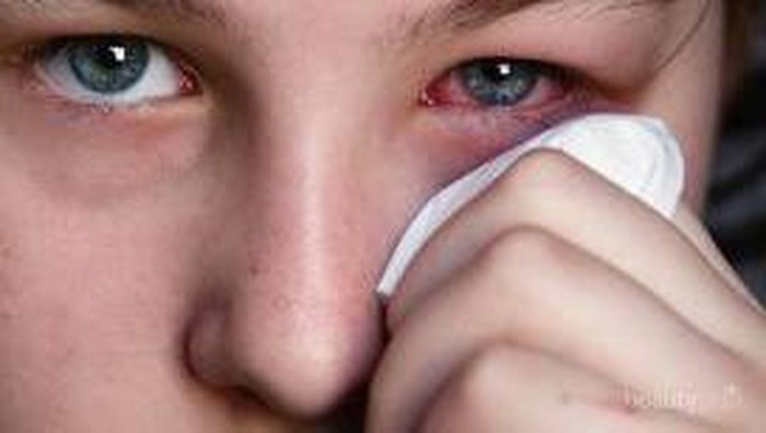 7 Cara Alami Mengobati Iritasi Mata