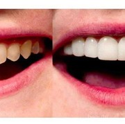 [FORUM] Veneer gigi??