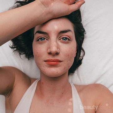 img-title Tidak Disangka, 4 Cara Mencuci Muka Ini Malah Menimbulkan Jerawat pada Wajah Kamu, Lho!