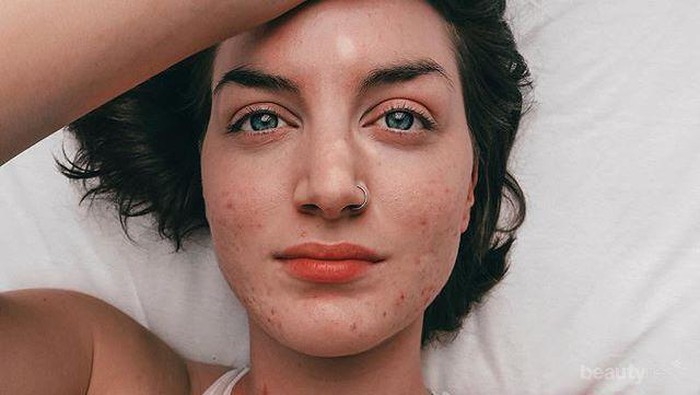 Tidak Disangka, 4 Cara Mencuci Muka Ini Malah Menimbulkan Jerawat pada Wajah Kamu, Lho! Tidak Disangka, 4 Cara Mencuci Muka Ini Malah Menimbulkan Jerawat pada Wajah Kamu, Lho!