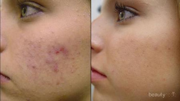 Rangkaian Produk Ampuh Paula's Choice Untuk Mengatasi Jerawat