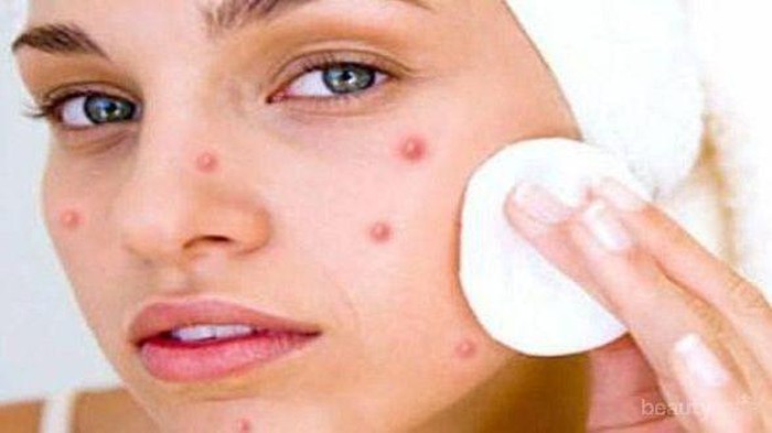 Menutupi Noda Jerawat dengan Makeup