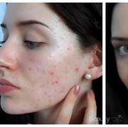 Makeup untuk Tutupi Masalah Jerawat