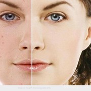 Tips Makeup Aman Saat Berjerawat