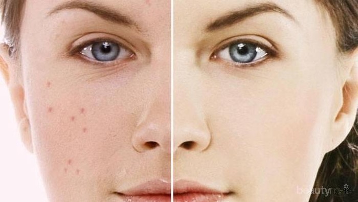 Tips Makeup Aman Saat Berjerawat