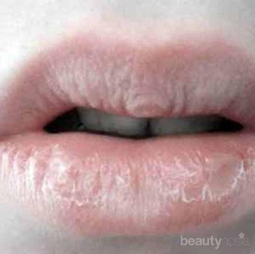 Bibir Kering Saat Puasa? Simak Tips Berikut untuk Mengatasinya