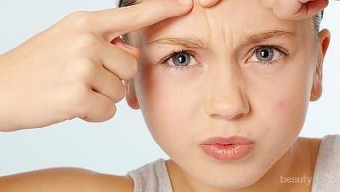 Atasi Masalah Jerawat di Rumah Dengan Cara Ini