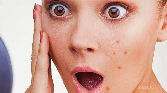 Melawan Jerawat Dengan Bahan Alami