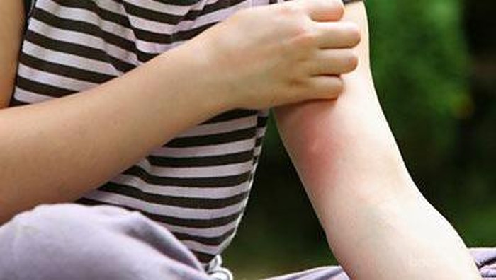 Cara Menghilangkan Bekas Gigitan Nyamuk Secara Alami dengan Air Jeruk Lemon