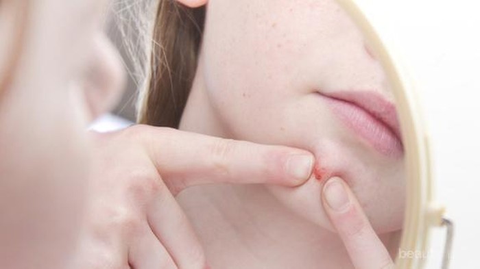 5 Cara Ampuh Mengatasi Jerawat Di Dagu