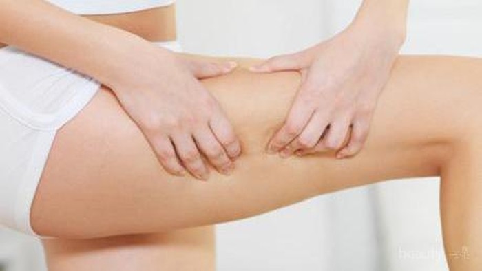 6 Penyebab Munculnya Stretch Mark