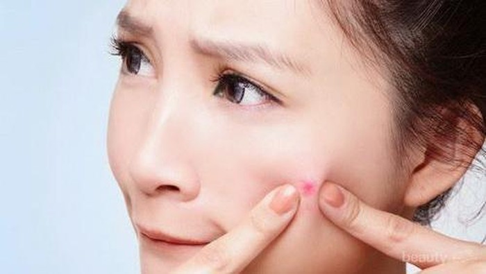 5 Kebiasaan Yang Membuat Jerawat Semakin Meradang