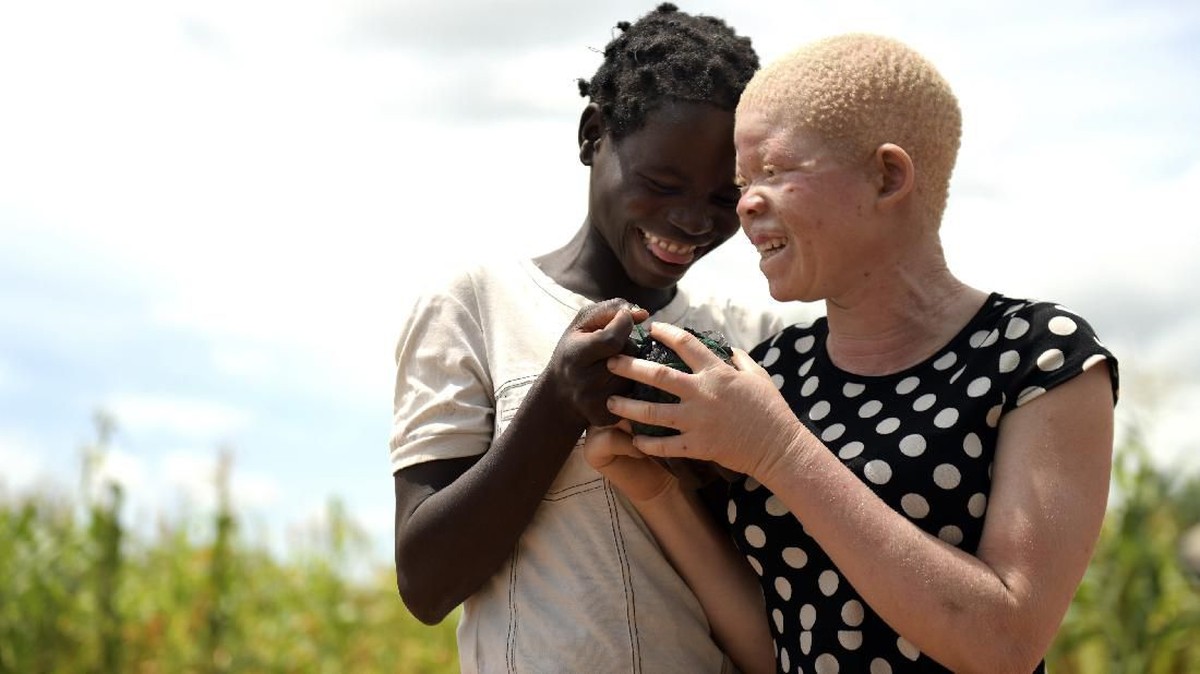 FOTO: Nasib Orang Albino di Malawi Hidup dalam Ketakutan