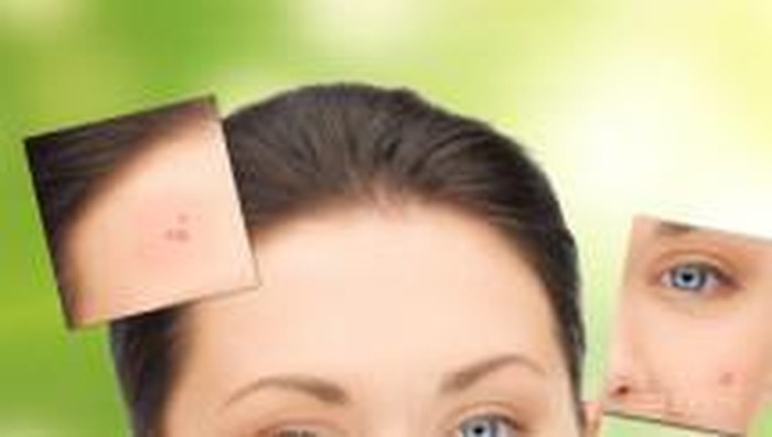 Jerawat di Wajah Memberi Sinyal Kondisi Tubuh