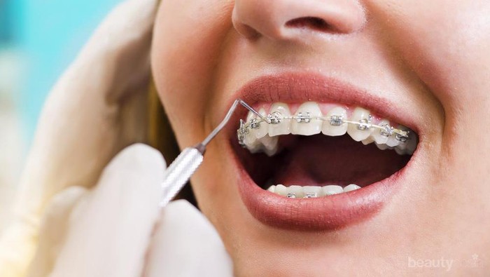 Inilah yang Harus Diperhatikan Jika Pasang Kawat Gigi