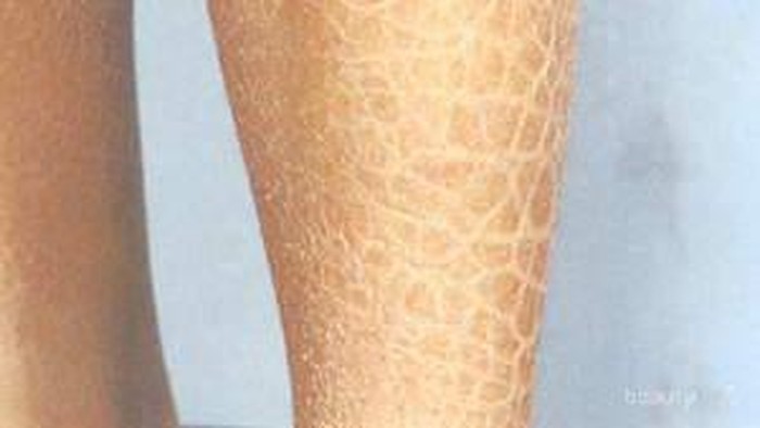 9 Kebiasaan Buruk yang Bisa Membuat Kulit Menjadi Kering