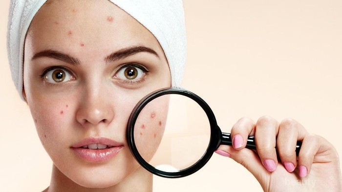 7 Kebiasaan Buruk Penyebab Kulit Berjerawat