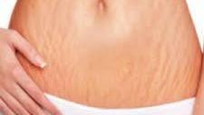 Cara Alami Mengatasi Stretch Mark