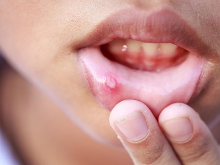 9 Obat Sariawan Anak Alami yang Bisa Bunda Buat di Rumah