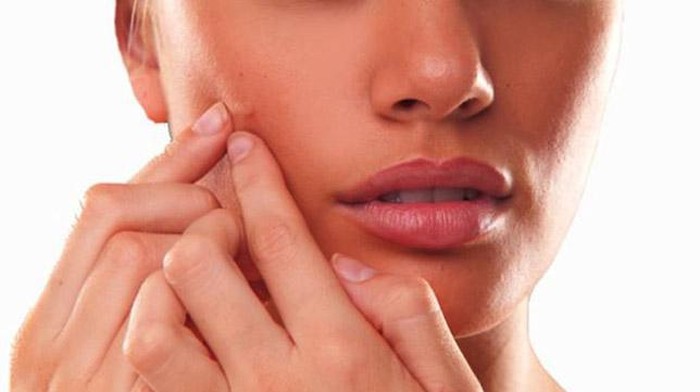 Tips Menghilangkan Jerawat dari Pakar Kecantikan