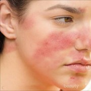 [FORUM] Skincare yang cocok untuk kulit acne-sensitif