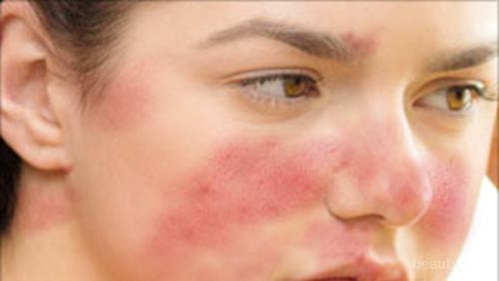 [FORUM] Skincare yang cocok untuk kulit acne-sensitif