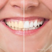 [FORUM] Habis Bleaching Gigiku Jadi Lebih Sensitif..