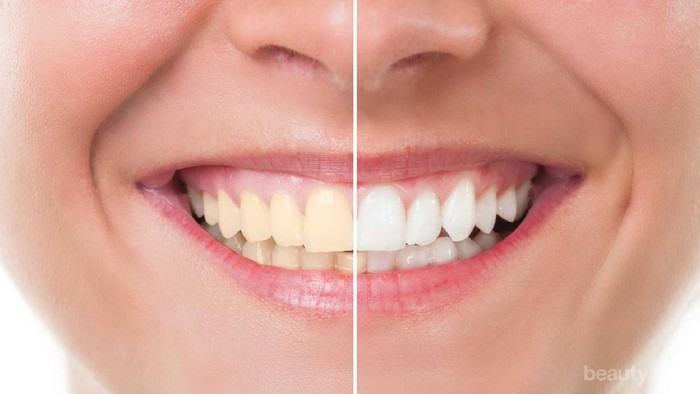 [FORUM] Habis Bleaching Gigiku Jadi Lebih Sensitif..