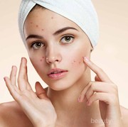 Untuk Kulit Berjerawat, Apa Sih Jenis Makeup yang Harus Dihindari