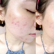 [FORUM] Ada produk yang ampuh hilangkan bekas jerawat?