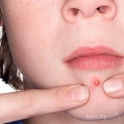 [FORUM] Suka gemes ngga sih kalau ada jerawat, maunya dipencet aja