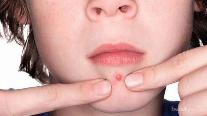 [FORUM] Suka gemes ngga sih kalau ada jerawat, maunya dipencet aja