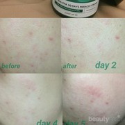 [FORUM] Dear ladies, aku pakai MIRACLE CREAM SOME BY MI tapi panas dan gatel... mohon sarannya