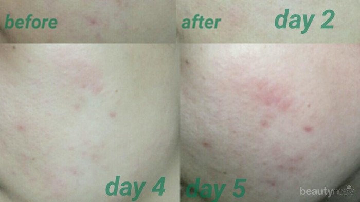 [FORUM] Dear ladies, aku pakai MIRACLE CREAM SOME BY MI tapi panas dan gatel... mohon sarannya