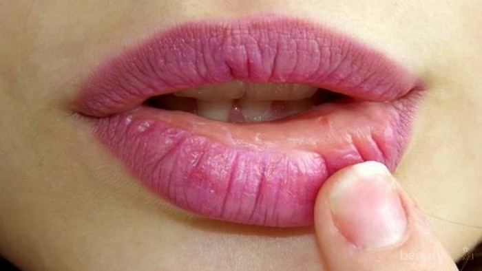 [FORUM] Suka gemes gak sih ngelupas bibir pecah-pecah sampai berdarah?