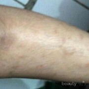 [FORUM] Gimana cara menghilangkan bekas gigitan nyamuk bertahun tahun?