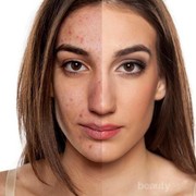 [FORUM] Cara menghilangkan bekas jerawat yang paling ampuh gimana kak?