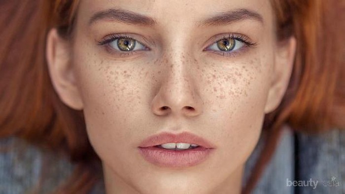 [FORUM] Freckles di wajah apakah bisa dihilangkan?