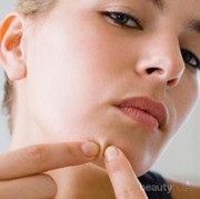 [FORUM] Kalau lagi ada jerawat matang, kamu pencet atau diamkan?