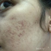 [FORUM] Rekomendasiin produk yg cocok dong buat ngilangin bekas jerawat merah2 untuk kulit berminyak dan cenderung berjerawat?