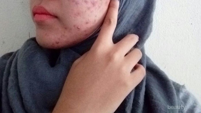 [FORUM] Jerawat sampai keluar nanah, bahaya ya?