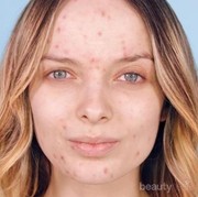Ternyata Ini Lho Arti Posisi Jerawat di Wajah Kamu, Ladies!
