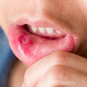 [FORUM] Rekomendasi obat saat sariawan yang bagus dong say