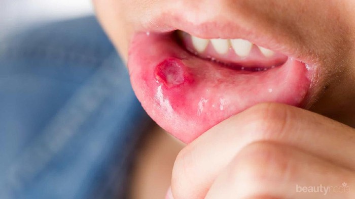 [FORUM] Rekomendasi obat saat sariawan yang bagus dong say