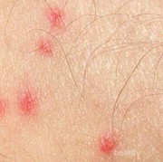[FORUM] Ada yang tau cara hilangin bintik merah bekas gigitan nyamuk?