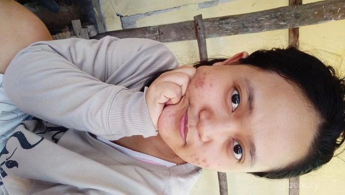 [FORUM] Tanya dong skincae buat hilangkan bekas jerawat