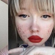 [FORUM] Lebih sedih kalau tiba-tiba muka bruntusan atau muncul jerawat?