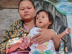 Sedih, Tangan Bayi 11 Bulan Asal Sragen Ini Terancam Diamputasi