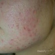 [FORUM] Dermal Punch Prp, Treatment Kecantikan untuk menghilangkan jerawat & Mengecilkan Pori-pori-pori